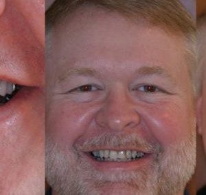 male patient before and after treatment